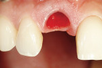 Figure 14  Atraumatic tooth removal.