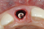 Figure 16  Peri-implant alveolar defect.