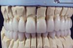 Figure 3 IPS e.max restorations were fabricated in the laboratory and seated onto the model.