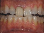 Figure 1 Patient presents with a provisional on tooth No. 8.