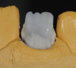 Figure 16 Opacious dentin buildup.