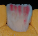 Figure 19 Opacious dentins used as modifiers.