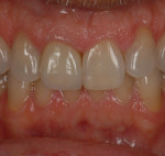 Figure 30 Final restoration with composite build on tooth No. 9.