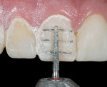 Figure 16  A course diamond bur is then used across the whole facial surface.