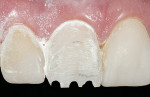 Figure 18  Several depth cuts were made at the incisal edge.
