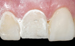 Figure 19  Controlled incisal edge reduction of 1.4-mm.