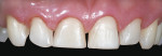 Figure 21  Final preps maxillary anterior teeth.