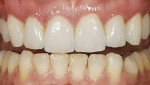 Figure 23  Postoperative view of eight porcelainveneers that were prepared using this technique.