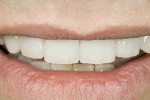Figure 24  Smile view with the new restorationsdemonstrating dento-facial harmony.