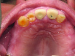 Figure 3 Patient with severe wear, multiple fractures, and tooth loss was unaware of grinding his teeth.
