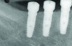 Radiograph of implants verifying that the
coded healing abutments were fully seated.