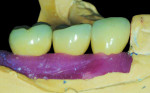 CAD/CAM abutments and PFM crowns seated on the Robocast with soft tissue.