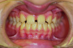 Figure 1 Pre-orthodontic anterior view.