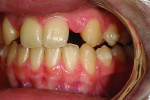 Figure 2 Post-orthodontic treatment; note the clear brackets on the mandibular first molars.