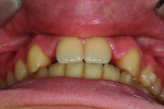 figure 4 Post-orthodontic anterior view.