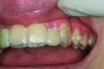 Figure 7 Delivering Invisalign modified temporary to develop the gingival contour.
