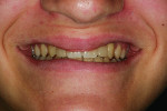 Figure 13 Smile view post-cementation of the conservative restorations to replace congenitally missing lateral incisors.