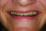 Figure 14 Smile view at 2-year follow-up visit.