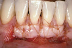 Figure 4a  Free gingival graft. Note the full epithelial coverage on the graft.