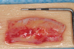 Figure 4b  Connective tissue graft. A small band of epithelium, demarcated by its lighter color, remains on the graft.