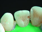 Figure 6 Initial penetration of maxillary lateral incisor demonstrates that the FOTI view was accurate, as caries extension was visualized.