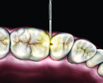 Figure 3 Use of specialized 0.75-mm light guide to better visualize interproximal caries through the marginal ridge.