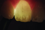 Figure 16 FOTI view of the maxillary central incisors portrays the complete extent of enamel discoloration.