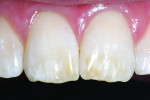 Figure 15 Clinical facial view of dental fluorosis on the maxillary incisors.