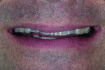 Figure 1 In this preoperative view, the short, broken, worn, and discolored teeth were evident.