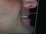 Figure 4 The patient exhibited a skeletal deep bite, Class I dental pattern tending to Class III skeletal tendency due to maxillary retrognathia.