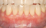 Figure 5d  Healing 18-month postsurgery. There is complete root coverage from tooth No. 22 through tooth No. 27.