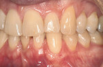 Figure 6a  Miller Class I recession from tooth No. 11 through tooth No. 13, and thin gingiva over teeth Nos. 8 through 10. Treatment goals included root coverage as well as gingival thickening to prevent future recession.