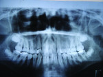 Figure 5 Initial panoramic x-ray taken to evaluate the gross structures of the head and oral cavity.