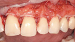 Figure 6b  Connective tissue graft in place. Note a small band of epithelium left on the graft around the cervical areas of the teeth.