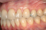 Figure 6c  Three-month postoperative photograph. There is complete root coverage of teeth Nos. 11 through 13 and thicker gingiva over teeth Nos. 8 through 10.