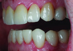 Figure 14 The definitive crowns were
tried in, cleaned with Ivoclean, and cemented
with Variolink luting composite according to the
manufacturer’s instructions.