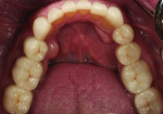 Figure 16 IPS e.max Press veneers were placed on teeth No. 22 through No. 27, and a NobelActive implant was inserted for tooth No. 3.