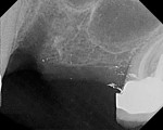 Figure 16 Case 2: Residual extraction defect No. 12 and limited subantral bone No. 14.