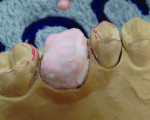 Figure 2 Deep dentin application (for color).