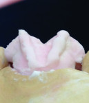 Figure 5 Creating the buccal line angles at a
45-degree running gingival one-third to
cusp tips.