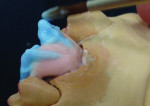 Figure 13 Creating the buccal line angles at a 45-degree running gingival one-third to cusp tip.