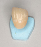 Figure 11  The all-ceramic CAD/CAM crown is cut back for porcelain build up.