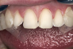 Figure 10  The etched incisors.