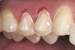 Figure 11  Example of the reduction required for posterior veneers.