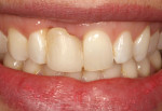 Figure 1. Pre-operative extraoral view of patient with significant loss of the papilla on the mesial aspect of tooth No. 7 and a high smile line.