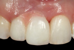 Figure 3. Artificial gingiva (pink autopolymerizing acrylic resin) was used to replace the lost papilla height. This served to communicate to the patient the visual endpoint.
of treatment as well
as how much orthodontic
eruption would be required
to correct the defect.