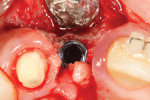 Figure 6. A papilla-sparing surgical incision design was used to preserve the interdental tissues during implant placement.
