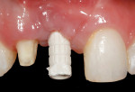 Figure 8. Following stage 2 implant uncovering and allowing the mucosal tissue to mature, a screw-retained temporary implant cylinder was seated to allow connection of an acrylic tooth.