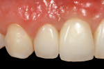 Figure 13. The veneered zirconia framework of splinted crowns on tooth No. 7 and implant No. 8 was cemented with provisional cement and maintained. The interdental papilla is still slightly shorter (more apical) than the papilla adjacent to tooth No. 9, and the papilla distal to tooth No. 7 is slightly longer after orthodontic correction.