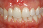 Figure 14. The definitive restoration, a tooth No. 7 crown splinted to implant crown No. 8, shows harmony in regard to the natural dentition as well as the reconstructed gingival architecture, which was improved employing forced orthodontic tooth eruption.